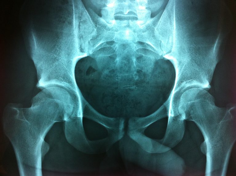 Osteoarthritis (OA) And Hip Arthroscopy - Hip Arthroscopy Australia